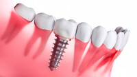 implantaciya-zubov